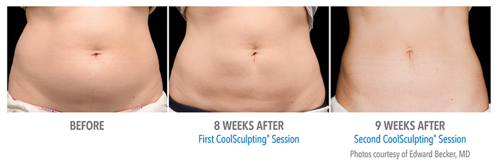 How Much Does CoolSculpting Cost